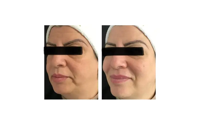 Harmonização Facial Natural: Benefícios e Procedimentos em Manaus